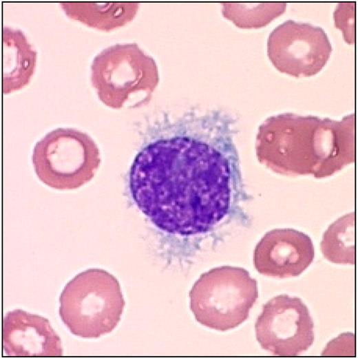 Figure 2. Typical leukemic cell in HCL. This figure (hairy cell) was obtained using an UPlanFL 100× Olympus objective in oil immersion. The image was collected using an MTI 3 CCD camera (DAGE-MTI Inc) with PAX-it 2.0 acquisition software (MIS).