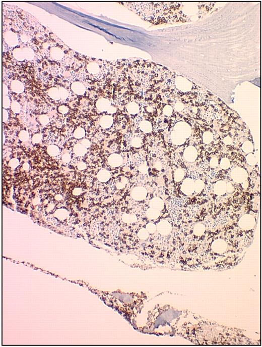 Figure 3. Bone marrow biopsy in HCL stained with anti-CD20 monoclonal antibody. This figure (HCL patient bone marrow biopsy) was stained with anti-CD20 monoclonal antibody (Dako North America) and detected using a horseradish peroxidase–conjugated mixed secondary detection system (LSAB; Dako North America). The image was obtained using an UPlanFL 20× Olympus objective. The image was collected using an MTI 3 CCD camera (DAGE-MTI Inc) with PAX-it 2.0 acquisition software (MIS).