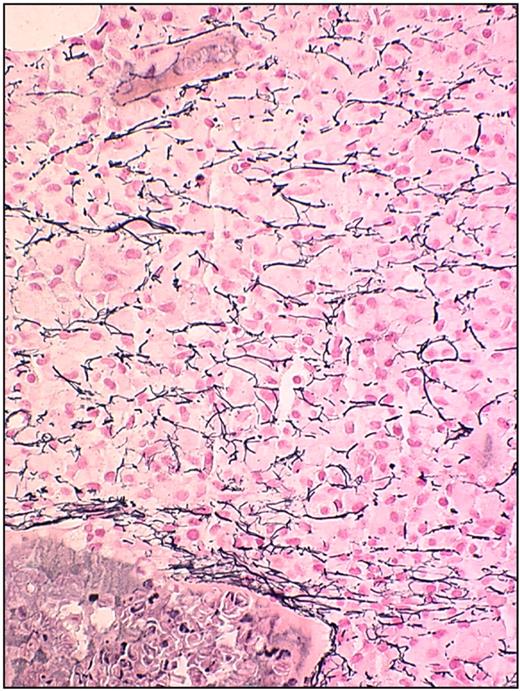 Figure 4. Bone marrow biopsy in HCL: reticulin stain. This figure (biopsy with reticulin stain) was stained using reagents according to the manufacturer's instructions (Ventana Medical Systems). The image was obtained using an UPlanFL 40× Olympus objective. The microscope used was an Olympus BX50 (Olympus America). The image was collected using an MTI 3 CCD camera (DAGE-MTI Inc) with PAX-it 2.0 acquisition software (MIS).