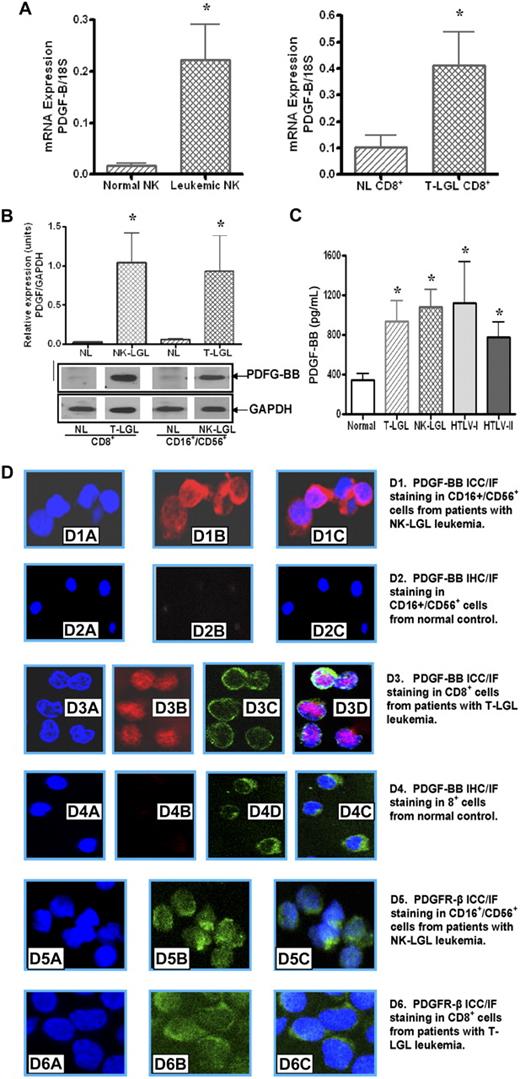 Figure 1. Leukemic LGLs express PDGF-BB and PDGFR-β. (A) PDGF-BB mRNA expression levels in NK cells from patients with NK-LGL leukemia and normal controls, and in T cells from patients with T-LGL leukemia and normal controls, were determined by real-time quantitative RT-PCR (expressed as the ratio of PDGF-BB mRNA copies/18S control mRNA copies; *P < .05). (B) Western blot analysis was performed for PDGF-BB production in cells lysates of CD16+/CD56+ cells from patients with NK-LGL leukemia or CD8+ cells from patients with T-LGL leukemia as well as in their counterpart cells from normal controls. GAPDH detection was used to confirm equal loading of total protein in each sample. Densitometry was performed on these Western blot results to determine the average level of PDGF-BB protein expression. *P < .05. (C) PDGF-BB protein expression in plasma samples from 10 normal controls, 9 NK-LGL leukemia patients, 10 T-LGL leukemia patients, 4 HTLV-I–infected persons, and 4 HTLV-II–infected persons was determined by ELISA; *P < .05 compared with plasma sample levels from normal controls. (D) PDGF-BB protein ICC/IF staining as visualized by confocal microscopy in LGL leukemia cells compared with normal T or NK cells. Nuclei staining was visualized by DAPI (blue); PDGF-BB, by Cy5 fluorescent staining in the cytoplasm compartment (red). CD8 surface marker on T cells was visualized by FITC-fluorescent staining on the cell membrane (green). (D1-2) NK cells from a patient with NK-LGL leukemia and a normal control. Nuclei staining (D1A,2A), PDGF-BB staining (Dib-iib), and merged image (Dic-iic). (D3-4) CD8+ cells from a patient with T-LGL leukemia and a normal control. Nuclei staining (D3A-4A), PDGF-BB staining (D3B,4B), CD8 surface marker (D3C,4C), and merged image (D3D,4D). (D5-6) PDGFR-β staining on NK cells and T cells from a patient with NK-LGL (D5) and T-LGL leukemia (D6), respectively. Nuclei staining: D5A, D6A; PDGFR-β: D5B, D6B; and merged images: D5C, D6C.