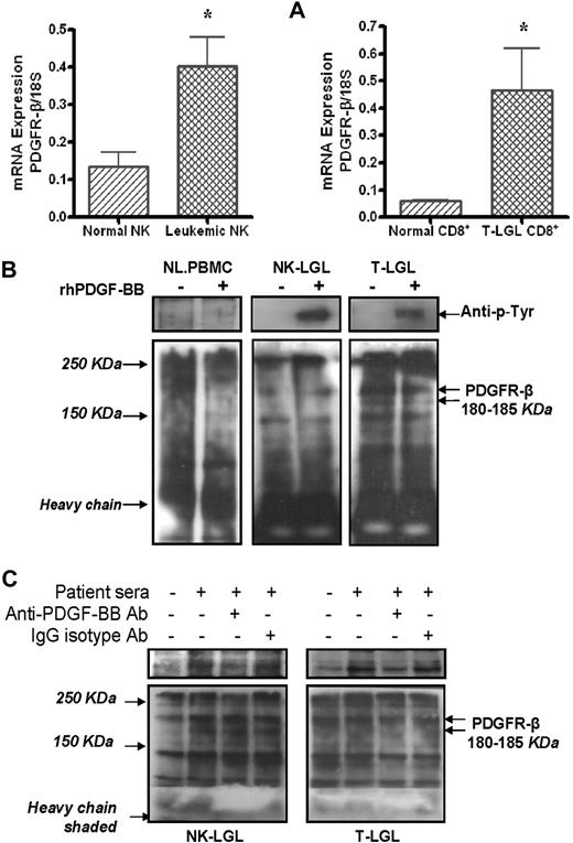 Figure 2. PDGFR-β expression and downstream activation in LGL leukemia. (A) PDGFR-β mRNA expression levels in CD3−/CD16+/CD56+ NK cells from either 7 patients with NK-LGL or 7 normal controls, and in CD8+ T cells from either 5 patients with T-LGL leukemia or 5 normal controls, were determined by real-time quantitative RT-PCR (expressed as the ratio of PDGFR-β mRNA copies/18S control mRNA copies, *P < .05). (B) Western blot assay for PDGFR-β and autophosphorylated PDGF-β-RTK expression in immunoprecipitation samples in PBMCs from a representative patient with T-LGL or NK-LGL leukemia as well as normal controls in presence or absence of rhPDGF-BB. (C) Western blot assay for PDGFR-β and autophosphorylated PDGF-β-RTK expression in immunoprecipitation samples in PBMCs from a representative patient with T-LGL or NK-LGL leukemia in the presence of pooled patient sera with or without anti–PDGF-BB neutralizing antibody. Rabbit IgG was used for isotype control. The gels in top panels indicate autophosphorylated PDGF-β-RTK expression in the same membranes used for PDGF-βR detection (bottom panel) reblotted using anti–p-Tyr antibody (PY99).