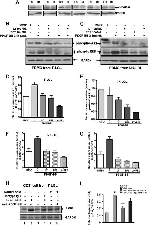 Figure 3. PDGF-BB mediates downstream target AKT/ERK pathway activation via PI3K and SFK pathways in leukemic LGLs. (A) Western blot assay was carried out for SFK protein expression in PBMCs from 6 patients with T-LGL leukemia (LGL) and 6 normal controls (NL). The gels in the bottom panel indicate SFK expression of 60 KDa molecular weight. Kinase assay (top panel) was performed in IP samples to determine SFK activities (enolase). (B-C) Phospho-AKT and phospho-ERK (p44/42 MAPK) expression was determined in PBMC lysates from a representative patient with T-LGL leukemia (B) and a patient with NK-LGL leukemia(C) using Western blot assay. Western blot assay for GAPDH expression was performed to confirm equal loading of total protein in each lane. (D-G) Densitometry analysis was performed on Western blot results from 3 patients with T-LGL leukemia (D,F) and 3 patients with NK-LGL leukemia (E,G) to determine the average level of phospho-AKT expression (D-E) or phospho-ERK expression (F-G). Data expressed as relative expression units of p-AKT/GAPDH or p-ERK/GAPDH ratios. (H) Western blot assay was performed for phospho-AKT protein expression in lysates of CD8+ cells from a representative patient with T-LGL leukemia. Cells received different treatments as indicated. (Lane 1) Medium only. (Lane 2) Ten percent pooled sera from 3 patients with T-LGL leukemia. (Lanes 3,6) Ten percent pooled sera from either T-LGL leukemia patients or normal controls that received 2-hour preincubation with anti–PDGF-BB neutralizing antibody. (Lane 4) Ten percent pooled sera from patients with T-LGL leukemia that received 2-hour preincubation with IgG isotype control antibody. (Lane 5) Ten percent pooled sera from 3 normal controls. Western blot analysis for GAPDH was performed to confirm equal loading of total protein in each lane. (I) Densitometry was performed for Western blot results from 3 different experiments to determine the average level of phospho-AKT protein expression. *P < .03, no treatment control (NTC) versus 10% T-LGL patient sera treatment; **P < .05, treatment with 10% patient sera versus treatment with 10% patient sera preincubated with anti–PDGF-BB neutralizing antibody.
