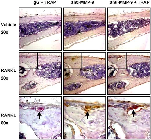 Figure 6. MMP-9 is predominantly expressed by osteoclasts in mouse calvaria. Serial coronal sections of vehicle or RANKL-treated mouse calvaria were stained for TRAP (red), MMP-9 (brown), or IgG as indicated. represents an osteoclast present in 3 serial sections, positive for both TRAP and MMP-9. Insets shown at original magnification ×60 are indicated by boxes. Images were acquired with a Nikon Eclipse E800 microscope fitted with a Plan Fluor 20×/0.5 NA objective or Plan Apo 60×/1.4 NA objective (oil), and an Olympus America SN CG603057-H camera with Magnifire software. Auto contrast adjustments were performed with Adobe Photoshop software (original magnifications: ×20 or ×60 as indicated). Results are from 1 representative experiment of 2 performed.