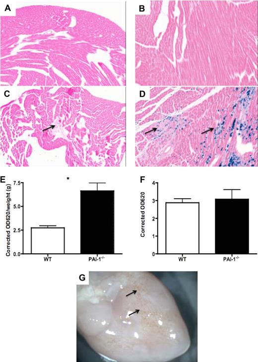 Figure 5. Spontaneous bleeding and increased vascular permeability in PAI-1−/− hearts. Prussian blue staining of 12- and 48-week WT (A-B) and PAI-1−/− (C-D) hearts revealed hemosiderin deposition in 12-week PAI-1−/− hearts (C, ↑), indicating bleeding before fibrosis formation. Hemosiderin deposition was overt in 48-week PAI-1−/− hearts (D). An in vivo vascular permeability assay revealed increased cardiac vascular leakage in 12-week PAI-1−/− hearts (E). The plasma levels of EB were the same between WT and PAI-1−/− mice (F). Gross photograph of PAI-1−/− hearts at 48 weeks is shown (G), where hemorrhage spots are observable macroscopically (↑). n ≥ 5 for each age group; *P < .05.