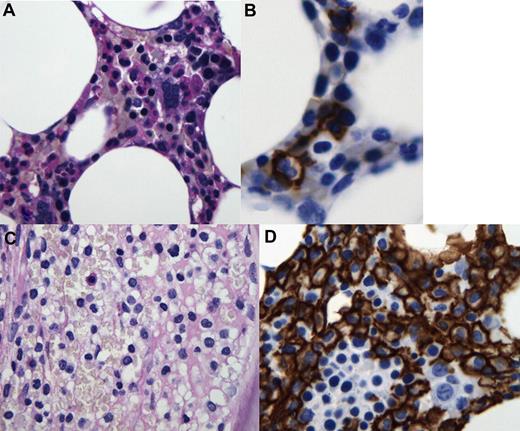 Figure 1. Examples of residual HCL in bone marrow specimens. (A) Bone marrow biopsy from patient 10 with MRD showing normocellular hematopoiesis with no morphologic evidence of an abnormal lymphoid infiltrate (periodic acid–Schiff, original magnification ×400). (B) CD20 immunostain of the bone marrow biopsy from patient 10 with MRD showing scattered abnormal B cells. The illustrated cell has a bilobed nucleus, abundant cytoplasm, and bright coarse CD20 positivity, all characteristic features of HCL (CD20 immunostain/hematoxylin, original magnification ×1000). (C) Bone marrow biopsy from patient 19 with gross morphologic disease showed multiple areas of lymphoid infiltrate. The infiltrate was loosely cellular with monotonous small lymphocytes with nuclear features and abundant cytoplasmic domains imparting a “fried egg” appearance characteristic of HCL (periodic acid–Schiff, original magnification ×400). (D) CD20 immunostain of the bone marrow biopsy from patient 19 with gross morphologic disease shows extensive involvement by a B-cell infiltrate with features of HCL. Both patients had their diagnosis confirmed by flow cytometry that showed a CD11c, CD25, and CD103+ population of monoclonal B cells.