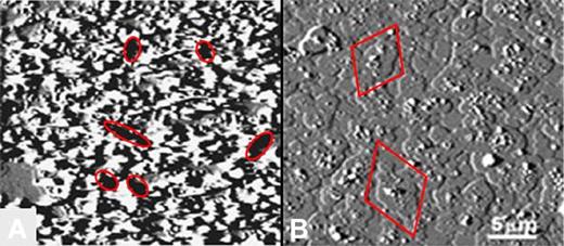 Figure 5. End point AFM imaging of effects of HCQ on AnxA5 crystallization. (A) In the absence of HCQ, aPL mAb with β2GPI markedly disrupted the normally smooth AnxA5 crystalline array, as previously described.7,12 The dark zones present throughout the image (6 of which are demarcated by ellipses) indicate markedly decreased height measurements that are consistent with exposure of phospholipid bilayer (size range 0.5-2 μm), 6 of which are demarcated by ellipses.7,12 (B) Addition of HCQ prevented this marked disruption of AnxA5 crystallization and resulted in a cobbled surface that is entirely covered by patches of AnxA5 (size range 1.5-4.5 μm; 2 of which are demarcated by diamonds).