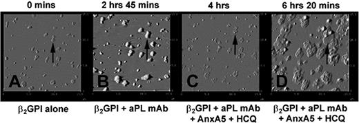 Figure 6. Dynamic AFM imaging of effects of HCQ on AnxA5 crystallization.(A) The binding of β2GPI to phospholipid bilayer after overnight incubation at 4°C resulted in formation of clusters of the protein. An arrow indicates one of these clusters as a representative reference point for the subsequent sequences. (B) The binding of aPL mAb, IS4, to β2GPI clusters showing the formation of aPL IgG-β2GPI complexes with increased heights and thickening of each of the clusters (arrow). (C) Addition of HCQ and AnxA5 resulted in the erosion of the complexes (arrow), as previously described, and (D) formation of “cobblestones” of Anx A5 that formed over and around the remnants of the aPL mAb-β2GPI complexes (arrow). The appearances of the AnxA5 patches are identical to the formations shown in the endpoint experiment of Figure 5B. All above 15 μm × 15-μm amplitude images were electronically zoomed from an original 30 μm × 30-μm scan.
