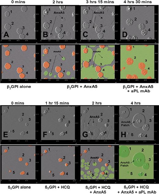 Figure 7. Dynamic AFM imaging of HCQ-induced formation of formation of AnxA5 layer over aPL IgG-β2GPI complexes. Each original AFM amplitude image (top panel) is paired with a colorized version (bottom panel) for explanation. In a sequence performed without HCQ, (A) the addition of β2GPI to phospholipid bilayers resulted in the formation of clusters (marked 1-4, orange circles in colorized version), as previously described.41 (B) Addition of AnxA5 resulted in the initiation of 2-dimensional crystallization (flat round structures, green in colorized version) arising from different nucleation points, which (C) enlarge, merge, and grow toward each other, as previously described,7 until they covered all of the bilayer not occupied by the β2GPI cluster. (D) Subsequently added aPL mAb bound to the surfaces of β2GPI clusters. In a sequence that included HCQ, (E) addition of β2GPI to phospholipid bilayers and formation of β2GPI clusters (marked 1-5) were followed by (F) addition of HCQ, followed by (G) addition of AnxA5, which at first crystallized from multiple different nucleation sites on the phospholipid bilayer, (H) and then formed a secondary layer of AnxA5 over the β2GPI, which progressively grew around and over the adjacent primary layer of AnxA5 crystal, leaving none of the surface uncovered by AnxA5.