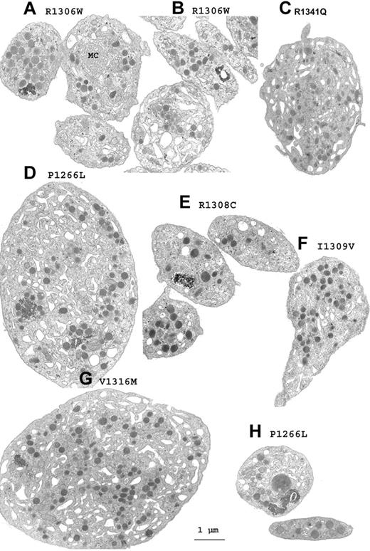 Figure 1. A gallery of electron micrographs of platelets from patients with VWD2B. (A-B,E) Platelet agglutinates. (A) Membrane complexes (MCs) in an enlarged platelet. (D) Giant platelet from P1 with the P1266L mutation where high-molecular-weight (HMW) multimers are present despite a positive RIPA. (H) α-granule of increased size for P1. (G) Giant platelet from P6 with the V1316M mutation. (C,F) Enlarged platelets of abnormal form are shown for P7 (C) and for P4 (F). Many of the illustrated platelets contain increased amounts of surface-connected canalicular systems, and the granules are not homogeneously distributed. Scale bar equals 1 μm for all the electron micrographs.