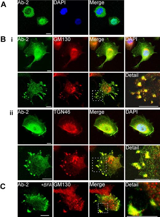 Figure 3. Immunofluorescent detection of FXIII-A in THP-1 cells. (A) The distribution of fluorescence for Ab-2 in fixed permeabilized nonadherent THP-1 cells was predominantly cytoplasmic in certain cells (top left) but predominantly nuclear in other cells (bottom right). (B) Adherent PMA-differentiated THP-1 cells were treated for 6 days with IL-4 (20 ng/mL). After fixation and permeabilization cells were probed with anti–FXIII-A antibody Ab-2 and with antibodies to Golgi markers GM130 (Bi) and TGN46 (Bii). In the majority of cells (shown in top rows in Bi-ii), Ab-2 fluorescence was distributed throughout the cytosol and nucleus. Ab-2 fluorescence was concentrated in the perinuclear area where it overlaid Golgi cisternae, but the regions of greatest intensity of Golgi and Ab-2 fluorescence did not correspond. In occasional cells (shown in bottom rows in Bi-ii), Ab-2 and Golgi marker fluorescence colocalized in podosome-like membrane extrusions (yellow pixels). In a high proportion of cells in which Ab-2 fluorescence was apparent in the periphery, perinuclear FXIII-A fluorescence was notably reduced. (C) THP-1 cells, grown as in panel B, were treated for 1 hour with Brefeldin A (BFA; 10 μg/mL) before fixation and permeabilization. Immunofluorescence for FXIII-A and GM130 remained within peripheral plasma membrane–associated structures despite dispersion of perinuclear Golgi elements to vesicles.