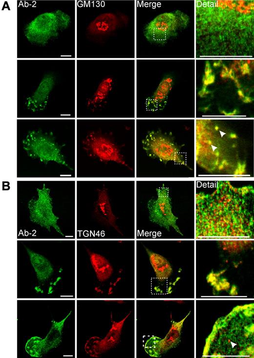 Figure 5. Immunofluorescent detection of FXIII-A in primary monocyte-derived macrophages. Macrophages were treated for 6 days with IL-4 (20 ng/mL). After fixation and permeabilization, cells were probed with anti–FXIII-A antibody Ab-2 and with antibodies to Golgi markers GM130 (A) and TGN46 (B). (A-B top rows) The morphology represents the majority of cells present, and in these cells Ab-2 fluorescence was distributed throughout the cytosol. (A-B middle rows) Macrophages are shown that exhibited a morphology characteristic of migrating cells. In these cells, Ab-2 and Golgi marker fluorescence were colocalized in plasma membrane–associated ruffles and podosome-like structures. (A bottom row) A cell shows podosomes and membrane blebs containing both FXIII-A and GM130. In addition, candidate transport vesicles are present (arrowheads). The intracellular topology of these vesicles is established in supplemental Figure 3B. (B bottom row) A cell shows extensive colocalization of FXIIIA and TGN46 to the plasma membrane in addition to their presence in podosome-like structures. A representative TGN46-positive but FXIII-A–negative vesicle is shown with an arrowhead. TGN46-positive vesicles were apparent in most macrophages examined but were negative for FXIII-A in all fields examined.