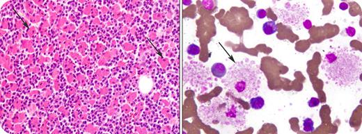 A 63-year-old male presented with progressive weakness, weight loss, and bone pains. Previous investigations showed normochromic normocytic anemia and a raised erythrocyte sedimentation rate. Further laboratory work-up revealed IgG κ monoclonal gammopathy in the serum. The IgG level was 31.90 g/L (normal, 6.94-16.18 g/L). Other laboratory tests showed hemoglobin 91.0 g/L, white blood cell count 8.9 × 109/L, platelet count 191 × 109/L, serum creatinine 247.52 μmol/L, and normal serum albumin and calcium. Skeletal survey showed generalized osteoporosis and multiple lytic lesions throughout the skeleton including the skull, mandible, ribs, scapulae, and left proximal humerus. Bone marrow contained 36% plasma cells along with numerous globular and crystalline-laden histiocytes (see arrows). The histiocytes were positive for CD68 immunostain and plasma cells expressed positivity for CD138. A diagnosis of crystal storing histiocytosis (CSH) in multiple myeloma was made. / CSH is a rare morphologic finding characterized by accumulation of monoclonal immunoglobulin light chains within histiocytes. It is seen in B-cell lymphoproliferative disorders, most commonly in multiple myeloma, and is usually associated with IgG paraprotein and kappa light chain accumulation. CSH has also been seen in other tissues including kidneys, spleen, lymph nodes, skin, thyroid, lungs, and gastrointestinal tract. There is no intervention aimed specifically at CSH. Therapy is directed against the underlying hematological malignancy.