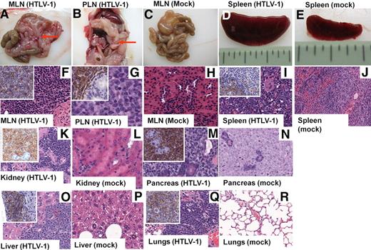 Figure 1. Lymphomagenesis in HTLV-1 HU-NOD/SCID mice. Representative histologic analysis of HTLV-1-HU-NOD/SCID mice and mock mice killed 14 to 16 weeks after reconstitution. Development of lymphomas localized to the mesenteric (MLN) and lymph nodes surrounding the pancreas (PLN; red arrows) and spleen (A-B,D) in HTLV-1-HU-NOD/SCID mice in comparison with mock-infected HU-NOD/SCID mice (C,E). H&E staining of MLN (F), pancreatic lymph nodes (G), and infiltrating lymphocytes in spleen (I) of HTLV-1-HU-NOD/SCID mice in contrast to lymph nodes (H) and spleen (J) of mock-infected HU-NOD/SCID mice. H&E staining shows diffuse large scale lymphomas in the kidney, pancreas, liver, and lungs (K,M,O,Q) of HTLV-1-HU-NOD/SCID mice in comparison with kidney, pancreas, liver, and lungs (L,N,P,R) of mock-infected HU-NOD/SCID mice. Insets (K,M,O,Q) show immunohistochemical analysis for human CD45.