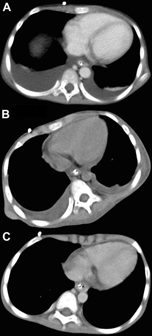 Figure 1. Administration of bevacizumab. Chest CT before (A), 5 days after (B), and 20 days after (C) treatment with bevacizumab.