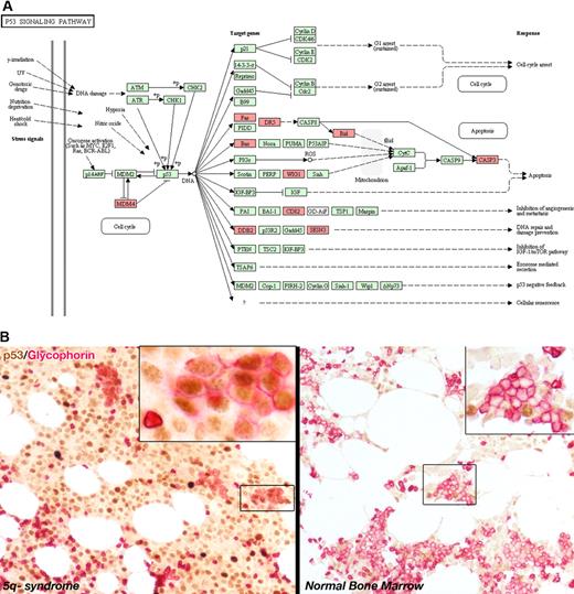 Figure 1. Analysis of p53 in the 5q− syndrome. (A) The p53 pathway as shown by the Database for Annotation, Visualization and Integrated Discovery (DAVID) gene ontology application (http://david.abcc.ncifcrf.gov/). Genes highlighted in red are significantly differentially expressed in patients with 5q− syndrome. (B) Double immunostaining for p53 (brown) and Glycophorin A and C (red) in 5q− syndrome (×20, inset ×60) and in normal (×20, inset ×40) bone marrow trephines. Immunostaining was performed on paraffin-embedded tissue sections of normal bone marrow trephines and MDS. The monoclonal antibodies for Glycophorin A (JC159), Glycophorin C (ret40f), and p53 (DO-7) were all obtained from Dako. Images were acquired on a Nikon Eclipse E400 microscope equipped with 10×/0.30, 20×/0.50, 40×/0.75 and 60×/0.85 Plan Fluor objective lenses, using a Nikon DS-5Mc digital camera (all from Nikon) and Adobe Photoshop CS3 Version 10.0.1 image processing/manipulation software (Adobe). In 5q− syndrome, clusters of p53-positive erythroblasts (boxed area shown at higher power in top right inset) were positive for Glycophorin (mature red cells were p53-negative). In the normal bone marrow, clusters of Glycophorin-positive erythroblasts were p53-negative (boxed area shown at higher power in top right inset).