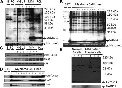 Figure 1. The sumoylation pathway is up-regulated in MM. (A) Sumo-1 immunoblot of protein lysate from myeloma patient PCs. Total lysate was prepared from 105 cells and separated by electrophoresis on 5% to 20% gradient gels. (B) Sumo-1 immunoblot of total protein lysate from MMCLs. Total lysates were analyzed as in panel A. Samples loaded were normal B cell, normal PC, and then samples from the MMCLs, which were: 1, RPMI 8226; 2, U266; 3, ARP1; 4, ARD; 5, OPM1; 6, OPM2; 7, MM1.S; 8, MM1.R; 9, LR5; 10, KMS, 28BM; 11, KMS, 28PE; 12, NCI, H929; and 13, INA6. (C) Sumoylation pathway components on MM patient samples. Total lysate prepared from 105 cells was separated by electrophoresis on 10% to 20% gradient gels. Samples were probed with antisera to Ube2I, PIAS1, and ARF as indicated. (D) Sumoylation pathway components in total lysates were analyzed as in panel A. Samples loaded were normal B cell, normal PC, and then samples from the MMCLs, which were: 1, RPMI 8226; 2, U266; 3, ARP1; 4, ARD; 5, OPM1; 6, OPM2; 7, MM1.S; 8, MM1.R; 9, LR5; 10, KMS-28BM; 11, KMS-28PE; 12, NCI-H929; and 13, INA6. Samples were probed with antisera to Ube2I, PIAS1, Nse2, ARF, and histone 1, respectively. (E) Sumo-1 immunoblot of protein lysate from 3 normal B-cell samples and from 3 myeloma patient PC samples. Total lysate was prepared, separated by electrophoresis on 5% to 20% gradient gels, and probed with a Sumo-1 antibody.