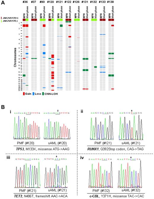 Figure 5. Gains and losses in matched MPN samples and mutational analysis. (A) Most commonly altered genomic regions in MPN samples (left sample column) compared with matched blast phase samples (right sample column) evolved from 11 patients (2 PV, 1 ET, 8 PMF). Each line represents 1 sample with either deletion (blue), duplication/amplification (red), or CNN-LOH (green). (Bi) Hemizygous TP53 mutation detected in MPN-blast phase sample of case 120 associated with acquired 17q deletion, which was not present in the MPN phase of case 120. (ii) Hemizygous RUNX1 mutation detected in MPN-blast phase sample (case 121) associated with acquired deletion at 22q22.1, which was not present in the MPN phase of case 121. (iii) Hemizygous TET2 mutation detected in MPN-blast phase sample of case 121 associated with acquired cryptic deletion on 4q24, which was not present in the MPN phase of case 121. (iv) Homozygous c-CBL mutation detected in MPN-blast phase sample of case 132 associated with acquired 11q CNN-LOH, which was not present in the MPN phase of case 132.