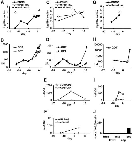 Figure 5. Clinical course and immune status in patients 4, 5, and 6 before and after EBV-specific T-cell transfer. Data are shown for patient 4 (A-B), patient 5 (C-F), and patient 6 (G-J). (A,C,G) EBV DNA levels in peripheral blood cells (copies per 20 000 cells), in throat lavage fluid (copies per milliliter), and in endotracheal suctioning (copies per milliliter). (B,D,H) Serum levels of transaminases (GOT indicates glutamic-oxaloacetic transaminase; GPT, glutamic-pyruvic transaminase) are expressed in U/L. (E,I) Absolute numbers of CD8+ and CD4+ T-cell subsets in peripheral blood. For patient 4, no data near the time of T-cell transfer were available. (F) Peripheral blood cells from patient 5 (day −13 and day 4) were stained with HLA-peptide pentamers for the EBNA3A epitope RLR or the irrelevant (mismatched) epitope EPL (see Table 5). In analysis, cells were gated on large lymphocytes. The proportion of pentamer-staining cells is shown. (J) Peripheral blood cells from patient 6 (day 6 after T-cell transfer) were tested in an IFN-γ ELISPOT assay for recognition of the matched EBV peptide RRIY, the mismatched peptide IPQC, or the mix of 23 EBV peptides. Negative control was without peptide, positive control was TPA (12-O-tetradecanoylphorbol-13-acetate) and ionomycin. (A-I) Indicated days are relative to T-cell transfer (day 0).