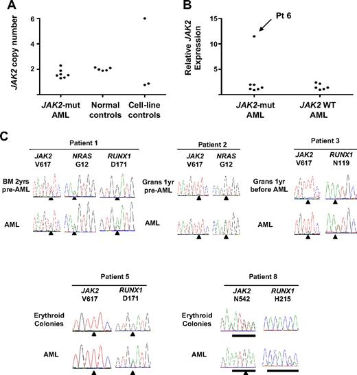 Figure 2. Genetic events associated with progression to acute myeloid leukemia after a JAK2-mutant MPN. (A) Assessment of JAK2 copy number in 7 JAK2-mutant leukemias with the use of a real-time PCR assay; samples from healthy persons and cell lines known to harbor a deletion of 9p (MDA-MB-361 and NB16) or multiple copies of JAK2 (HEL) are shown as controls. (B) Expression of total JAK2 measured by real-time PCR normalized to normal CD34+ cells showing a 12-fold increase in relative JAK2 expression in patient 6. (C) Mutation genotyping from 5 patients progressing to acute leukemia showing that, whereas RUNX1 mutations were acquired at the time of progression to AML, NRAS mutations may be associated with the preceding MPN. Mut indicates mutant; WT, wild-type; grans, purified granulocytes; and BM, bone marrow.