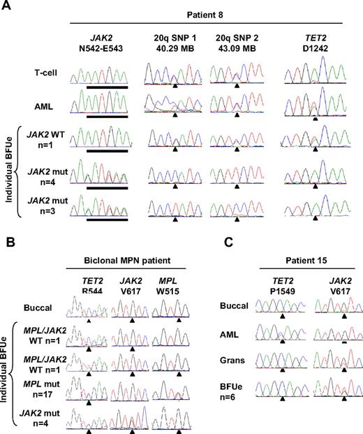 Figure 4. Clonal relationship of JAK2 wild-type leukemia to JAK2-mutant MPN with the use of 20q deletion or mutation in TET2 as a clonal marker. (A) Analysis of patient 8 showing a deletion of alternative 20q alleles in the MPN clone but no 20q deletion in the AML clone and a mutation of TET2 in leukemic blasts and a JAK2 wild-type erythroid colony but not in JAK2-mutant erythroid colonies. (B) Analysis of individual erythroid colonies from a patient harboring JAK2 V617F and MPL W515L mutations, showing that mutations in JAK2 and MPL are present in separate clones, with both clones have arisen from a shared TET2-mutant founder clone. (C) Analysis of patient 15 showing a mutation of TET2 in the JAK2 wild-type leukemia but not the JAK2-mutant MPN.