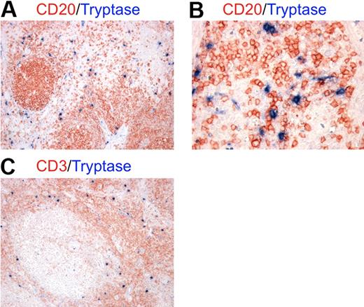 Figure 1. MCs localize in the paracortical and medullary area of lymph nodes in close contact with B cells. Double immunohistochemistry for mast cell tryptase and either CD20 (A-B) or CD3 (C) on lymph node samples with reactive follicular hyperplasia. (A-B) Mast cells (blue) are localized mainly in the parafollicular zone extending into the medullary area and showing tight spatial interactions with B cells (red). (C) In lymph nodes, MCs (blue) are likely to interact also with T cells (red) as the parafollicular area is rich in T lymphocytes. These pictures are illustrative of the interactions occurring between MCs and B cells in the context of T cell–rich areas of lymph nodes (STREPT-ABC and APAAP methods; original magnifications: panels A,C: ×100; panel B, ×200).