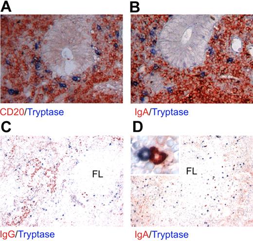 Figure 7. Colocalization between MCs and IgA-secreted plasma cell in inflamed mucosal tissue. (A-B) In the gut mucosa of patients with inflammatory bowel disease, MCs (A-B blue signal) accumulate at sites of inflammation where they colocalize with CD20-expressing B cells (A red signal) and IgA-secreting plasma cells (B, red signal). (C-D) In lymph nodes with reactive follicular hyperplasia, in which IgG class switch is prominent, the distribution of IgG-expressing plasma cells (C red signal) appears to be unrelated to that of MCs (C-D blue signal). By contrast, the few IgA-expressing plasma cells (D red signal) localize mainly in close proximity of MCs and even show signs of cell-cell contact (inset). (STREPT-ABC and APAAP methods; original magnifications: panels A-B, ×200; panels B-C, ×100; inset, ×400.)