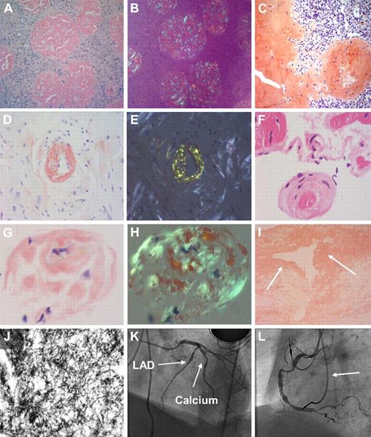 Figure 1. Morphologic findings in the common fibrinogen A α-chain amyloidosis E526 variant. (A) Congo red stain in renal biopsy (×100 magnification) in fibrinogen A α-chain amyloidosis. Extensive amyloid infiltrate with glomerular enlargement and replacement of the normal glomerular architecture by amyloid deposition, with almost no amyloid in the interstitium. (B) Same section as panel A viewed between crossed polars shows apple green birefringence typical of amyloid deposits. (C) Congo red stain in histologic sample from a ruptured spleen (×100 magnification) in AFib E526V exhibits extensive splenic amyloid deposits with predominantly trabecular and subcapsular distribution. (D) Endomyocardial biopsy specimen (×100 magnification) in a patient with AFib E526V and renal failure, with abnormal echocardiography (patient 19, Tables 1 and 2). Cardiac histology stained with Congo red demonstrates extensive, diffuse amyloid deposition in the myocardium. An endomyocardial vessel is demonstrated at the center of the section, showing complete replacement of its entire wall thickness by amyloid deposition. (E) Bright apple green birefringence of the amyloid deposits in myocardium and endocardial vessels of section in panel D under cross-polarized light. (F) Endomyocardial biopsy (×40 magnification) hematoxylin and eosin stain, in a patient with AFib E526V variant (patient 16, tables), on hemodialysis for 18 months, who had severe carotid atherosclerosis, and whose echocardiography showed normal wall thickness with impaired left ventricular relaxation. (G) Congo red stain demonstrates amyloid deposition at the periphery of an atrophic muscle fiber from the same sample (×100 magnification). (H) Apple green birefringence under polarized light in previous section. (I) Arterial intima atheroma (×100 magnification) excised during endarterectomy for the indication of 80% carotid stenosis in the same patient as in panels D and E. Congo red stain demonstrates extensive amyloid deposition within the intima and atheromatous plaque (arrows). The Congo red material exhibited strong apple green birefringence. Immunostaining with antifibrinogen antibodies was not performed because normal (wild-type) fibrinogen is expected to be part of the thrombus, and therefore a positive immunohistochemistry could not be reliably positive for a diagnosis of variant fibrinogen amyloidosis. (J) Transmission electron microscopy (×150 000 magnification) images of the atheroma in panel F demonstrates fibrillar material with fibril diameter of approximately 10 nm, compatible with amyloid. Fibril extraction and characterization revealed the amyloid atheromatous plaque to consist wholly of variant E526V fibrinogen. (K) Images from subsequent coronary angiography in the same patient, carried out to exclude significant asymptomatic coronary atherosclerosis as part of generalized amyloid angiopathy, in context of findings in panels F through I. Left anterior oblique cranial angiogram of left coronary artery shows diffuse atheroma in the left anterior descending coronary artery (LAD) with heavy calcification (arrows). (L) Left anterior oblique angiographic projection of the right coronary artery (same patient as in panel K) shows diffuse atheroma throughout its course. Leads from dual chamber pacemaker inserted for the indication of bradyarrhythmias are also shown (arrow).