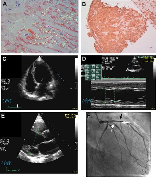 Figure 2. Dilated amyloid cardiomyopathy in fibrinogen A α-chain amyloidosis R554L variant. (A) Endomyocardial biopsy (×100 magnification) in a 55-year-old patient with the AFib R554L variant and stage II CKD, whose echocardiography during evaluation for combined LKT showed dilated cardiomyopathy with ejection fraction of only 25% (patient 18, tables). Endomyocardial histology shows bright apple green birefringence of diffuse Congo red–positive endocardial and interstitial amyloid deposits. No additional pathology or potential causes for dilated cardiomyopathy other than amyloidosis were identified. (B) Strongly positive fibrinogen immunohistochemistry using rabbit anti–human fibrinogen 1:200 (Dako Cytomation Inc), in the same section of panel A. (C) Apical 4-chamber 2-dimensional echocardiographic view at end diastole, demonstrating a dilated and globular left ventricular cavity. (D) Imaging from M-mode echocardiogram in the same patient, demonstrating increased left ventricular dimensions and reduced function. (E) Parasternal long axis echocardiographic images of increased left ventricular end diastolic dimensions. (F) Invasive angiogram of the left coronary artery (right anterior oblique projection), showing a 40% stenosis in the proximal anterior descending artery (black arrow), lumen irregularity, and more minor narrowing in the intermediate vessel (dotted white arrow) and narrowing in the first septal perforator (white arrow). The patient's right coronary had minor irregularity (not shown).