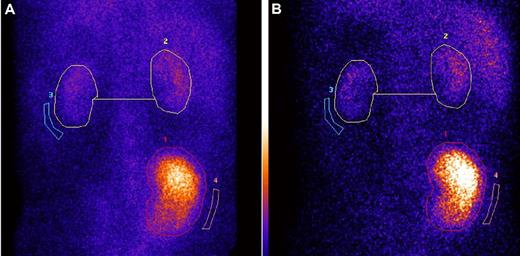 Figure 3. Serial 99mTc-DMSA scintigraphy shows stable renal graft: native kidneys divided function at 1 and 4 years after preemptive combined liver and kidney transplantation, in AFib E526. (A-B) Serial 99mTc-DMSA scintigraphy in an AFib E526V patient who received preemptive combined liver and kidney transplantation at stage 5 CKD, 1 month before scheduled commencement of hemodialysis. (A) Posterior view of dynamic renal scintigraphy at 1 year after combined liver and kidney function, 3 hours after injection of 80 MBq 99mTc-DMSA. Regions of interest (ROI; circles) shown are used in the calculation of divided function. The percentage of divided function is as follows: transplant kidney 86% and total native 14%. (B) DMSA scintigraphy in the same patient at 4 years after LKT. The panel shows posterior view scintigraphy 3 hours after injection of 80 MBq 99mTc-DMSA, and same regions of interest are used in the calculation of divided function. The percentage of divided function is as follows: transplant kidney 87% and total native kidney function 13%. We have confirmed by mass spectrometry19 in this patient that variant fibrinogen A α-chain has been completely eliminated from the plasma and is replaced by normal (wild-type) fibrinogen A α-chain after LKT.