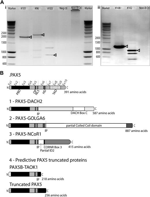 Figure 2. Cloning of novel PAX5 fusion partners by RCA-RACE. (A) RCA-RACE products were run on 1% agarose gel. Bands corresponding to amplified transcripts of fusion (i) or truncated genes (ii) are indicated by arrowheads. Additional bands correspond to amplification of fragments of wild-type PAX5 DNA. (i) Patient #101 amplified product corresponds to PAX5-NCoR1 fusion cDNA, #96 to PAX5-DACH2 fusion, #103 to PAX5-GOLGA6 fusion cDNA. (ii) Patient #108 product corresponds to truncated PAX5 cDNA, #102 to PAX5-TAOK1 fusion. (B) Schematic illustration of the fusion proteins predicted from cDNA sequencing, breakpoints (BP) are indicated by dashed lines. Ex1-10 indicates PAX5 exons. All fusion proteins retain the PAX5 DNA-binding domain (PBD, amino acids 16-142), the OP motif (amino acids 179-186), and NLS (amino acids 195-201). (1) PAX5-DACH2 contains the conserved coiled-coil domain of DACH2 (DACH-box C). (2) PAX5-GOLGA6 sequence contains a large part of a predicted coiled-coil domain of GOLGA6. (3) PAX5-NCoR1 retains part of the inhibitor of DNA-binding 2 (ID2) domain and the corepressor-nuclear receptor box 3 (CoRNR box 3). (4) PAX5-TAOK1 predictive protein contains an alternative amino acid sequence encoded by exon1B of PAX5 and an additional 17-amino acid tail, which does not correspond to any predictive functional domain. Truncated PAX5 contains N-terminal part of PAX5 (amino acids 1-201) and a 55-amino acid tail coded by the contiguous intron 5/intron 6 nucleotide sequence, which does not correspond to any predictive functional domain.