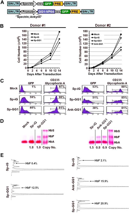 Figure 4. Induction of HbF by GG1-VP64 in erythroblasts derived from adult-mobilized PB CD34+ cells. (A) Schematic diagram of the empty vector control (top) and GG1-VP64-encoding vectors (bottom) where transcription is regulated by the erythroid-specific ankyrin-1 (Ank) or β-spectrin (Sp) promoters, respectively. The results obtained with 2 separate donors are shown in panels B to E. Abbreviated designation of the vectors are spectrin-ires-GFP control vector (Sp-iG), ankyrin-GG1-VP64-ires-GFP (Ank-GG1), and spectrin-GG1-VP64-ires-GFP (Sp-GG1). (B) Cell numbers as a function of time in culture after transduction. (C) Flow cytometry analysis for expression of GFP and CD235 (glyocophorin A) in erythroblasts at the end of culture where the percentages indicate the proportion of cells considered positive. (D) Hb electrophoresis of lysates from erythroblasts at the end of culture (vertical lines have been inserted to indicate a repositioned gel lane). Numbers below each lane on the images represent the VCN as determined by Southern blot analysis and densitometry analysis or quantitative PCR, for the various cell populations. (E) HPLC analysis of lysates from erythroblasts at the end of culture where the percentage of HbF is reported for each condition.