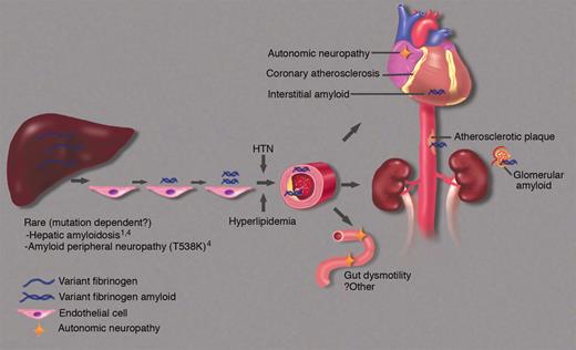 Pathogenesis of fibrinogen amyloidosis proposed by Stangou et al.1