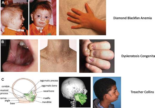 Figure 2. Selected physical abnormalities seen in ribosomopathies. (A) Left panel: Patient with DBA, illustrating the characteristic craniofacial abnormalities (courtesy of J. Lipton). Note the absent lower eyelashes, deformed external ears, and micrognathia. Second panel: An example of the triphalangeal thumb seen in DBA patients (courtesy of E. Atsidaftos and E. Muir). First panel: Reprinted from Lipton and Ellis9 with permission. (B) These panels illustrate the diagnostic triad of DKC, including dystrophic fingernails, lacy/reticular pigmentation on neck and trunk, and oral leukoplakia (courtesy of B. Alter). Reprinted from Savage and Alter10 with permission. (C) The craniofacial abnormalities of a patient with TCS are illustrated (courtesy of M. R. Passos Bueno). Note the down slanting palpebral fissures, malar and maxillary hypoplasia, and malformation of the ears. Reprinted from Passos-Bueno et al11 with permission.