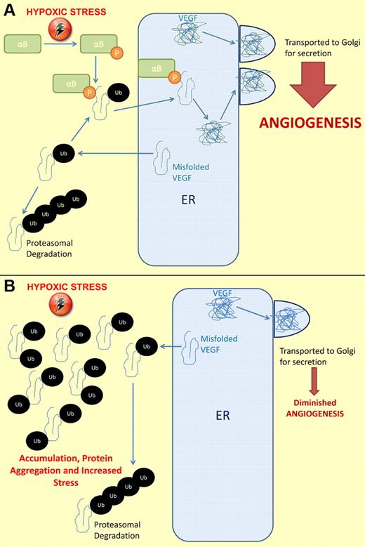 Hypoxic stress results in increased expression of vascular endothelial growth factor (VEGF), a known stimulator of angiogenesis. Increases in expression result in both properly folded and misfolded VEGF proteins. Misfolded VEGF is exported from the endoplasmic reticulum (ER) into the cytoplasm and ubiquitinated. (A) Hypoxic stress also stimulates phosphorylation of αB-crystallin (αB). Phosphorylated αB-crystallin binds misfolded, monoubiquitinated VEGF and returns it to the ER, where it is folded correctly and transported to the Golgi apparatus for secretion. Thus, the secretion of VEGF is up-regulated, angiogenesis occurs, and hypoxic stress may be reduced. (B) Properly folded VEGF is still transported to the Golgi and secreted. In the absence of αB-crystallin, misfolded, monoubiquitinated VEGF accumulates in the cytoplasm. Some of this will become polyubiquitinated and degrade. The rest of the misfolded VEGF can aggregate, leading to increased stress on the cell. Because misfolded VEGF cannot be transported back to the ER to be refolded, decreased secretion of VEGF occurs and hypoxic stress continues.