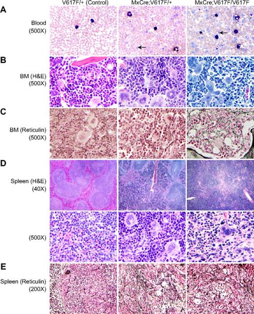 Figure 3. Histopathologic characterization of the MPN induced by Jak2V617F. (A) Peripheral blood smears show increased RBCs, leukocytes, and platelets in induced heterozygous and homozygous Jak2V617F mice (12 weeks after induction). Leukocytosis and thrombocytosis were more pronounced in homozygous Jak2V617F mice compared with heterozygous Jak2V617F animals. Arrows point to reticulocytes. (B) BM sections from induced Jak2V617F heterozygous and homozygous mice show trilineage hyperplasia (hematoxylin and eosin staining, ×500). (C) Reticulin staining on the BM sections (×500) shows mild fibrosis (grade 1) in older Jak2V617F heterozygous mice (24 weeks after induction), whereas homozygous mice show more reticulin fibrosis (grade 2) than heterozygous mice. (D) Spleens from heterozygous and homozygous Jak2V617F mice display extensive destruction of normal splenic architecture (×40 and ×500) with attenuated white pulp and markedly expanded red pulp, increased numbers of megakaryocytes, and clusters of immature erythroid precursors. (E) Reticulin staining of the heterozygous spleen shows increased fibrosis of the white pulp and slight reticulin fibrosis of the red pulp. Spleens from homozygous mice show pronounced reticulin fibrosis in the white pulp and also increased fibrosis in the red pulp compared with heterozygous mice.