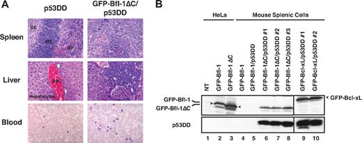 Figure 3. Histologic analysis reveals evidence of leukemia/lymphoma in GFP-Bfl-1ΔC/p53DD mice. (A top and middle) Spleen and liver sections from representative GFP-Bfl-1ΔC/p53DD or p53DD mice stained with hematoxylin and eosin. (Bottom) Peripheral blood smears from GFP-Bfl-1ΔC/p53DD or p53DD control mice stained with Wright-Giemsa. (B) Splenic cells recovered from diseased mice express GFP-Bfl-1ΔC or GFP-Bcl-xL along with p53DD as seen by Western blot, whereas those from healthy mice do not. The blot was probed with anti-GFP (top) or anti-p53 (bottom). HeLa cells transiently transfected with GFP-Bfl-1 or GFP-Bfl-1ΔC were used as controls.