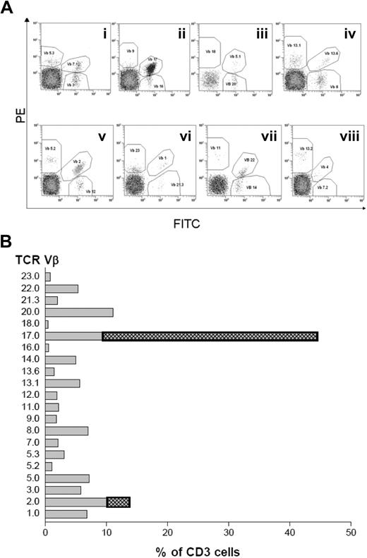 Figure 1. TCRVβ repertoire analysis by flow cytometry. (A) Expression of TCRVβ in PBMCs of a representative WM patient (patient no. 10) after cells were stained with a panel of TCRVβ antibodies from the Beta Mark kit and anti–CD3-ECD. (B) Percentage of CD3+ T cells expressing the TCRVβ of patient no. 10 compared with the mean ± 3 SD of the age-matched normal range.