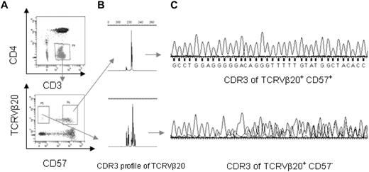 Figure 2. The nature of WM T-cell clonality from 1 representative WM patient (patient no. 4). (A) Flow cytometric cell sorting of CD3+CD4−TCRVβ+CD57+ and CD3+CD4−TCRVβ+CD57− cells from PBMCs of WM patient no. 4. (B) CDR3 length profile of CD3+CD4−TCRVβ+CD57+ and CD3+CD4−TCRVβ+CD57− cells using 6-FAM-Cβ and specific-Vβ20 primer for WM patient no. 4. (C) DNA sequence analysis in sorted cells from WM patient no. 4. The sequences are shown below the trace pattern.