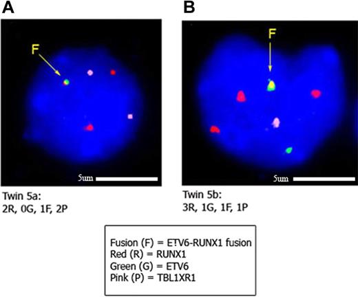 Figure 2. Interphase FISH to confirm CNAs identified by SNP array in twin set 5. Panels A and B show leukemic blasts from twins 5a and 5b, respectively, hybridized with the ETV6-RUNX1 ES (Vysis extra signal) probe and a fosmid probe (W12-1173N4) for the TBL1XR1 gene. The TBL1XR1 probe is labeled with biotin-16-dUTP and detected with streptavidin Cy5 (here pseudocolored pink). In panel A, the signal pattern of leukemic blasts in twin 5a is 1 yellow (corresponding to the ETV6-RUNX1 gene fusion), 2 red (1 corresponding to the normal RUNX1 gene and 1 to the residual RUNX1 gene disrupted by the translocation), and 2 pink (TBL1XR1 gene) signals. Note that the second green signal is not present, indicating loss of the normal (unrearranged) ETV6 gene. This pattern was observed in 21 of 31 cells scored. The other 10 of 31 cells had a normal pattern. In panel B, the signal pattern of leukemic blasts in twin 5b is 1 yellow (ETV6-RUNX1 gene fusion), 1 green (unrearranged ETV6), 3 red (corresponding to an additional copy of the RUNX1 gene), and 1 pink (corresponding to 1 copy of the TBL1XR1 gene). This accords with the SNP data indicating 3 discordant “driver” CNAs in this twin pair involving the ETV6, RUNX1, and TBL1XR1 genes. This pattern was observed in 31 of 32 cells scored.