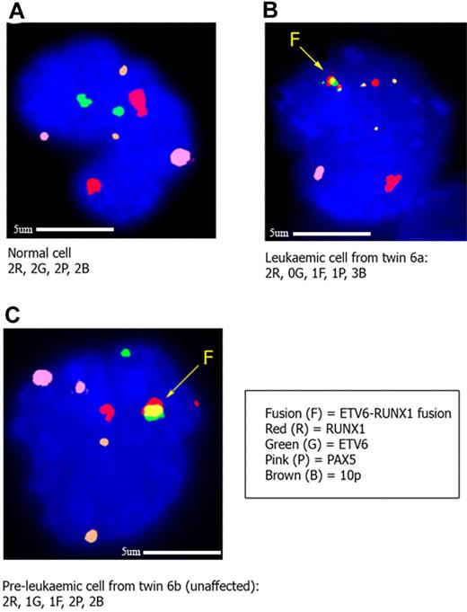 Figure 3. Interphase FISH to confirm CNA status in cells from twins clinically discordant for ETV6-RUNX1 positive ALL. In each case the ETV6-RUNX1 ES (Vysis extra signal) probe was cohybridized with a fosmid probe (W12-3139G6) for the PAX5 gene and a BAC probe (RP-675D23) for the region on 10p shown to be gained in the cells of the twin with leukemia by SNP array. The PAX5 probe is labeled with biotin-16-dUTP (pseudocolored pink), and the 10p probe is labeled with digoxigenin-11-dUTP (pseudocolored brown). In panel A, a normal bone marrow cell from the healthy twin (6b) shows 2 red (RUNX1 gene), 2 green (ETV6 gene), 2 pink (PAX5 gene), and 2 brown (10p) signals, respectively. In panel B, a leukemic cell from twin 6a shows 1 yellow (ETV6-RUNX1 gene fusion), 2 red (normal RUNX1 and remnant from rearranged RUNX1 gene, respectively), 1 pink (PAX5), and 3 brown (10p) signals, respectively. This confirms the findings by SNP array of a deletion of ETV6 and PAX5 and gain of 10p in this twin. In panel C, an ETV6-RUNX1 fusion gene positive cell in the unaffected twin (6b) has the following signal pattern: 1 yellow (ETV6-RUNX1 gene fusion), 2 red (normal and remnant from rearranged RUNX1), 1 green (normal ETV6), 2 pink (PAX5), and 2 brown (10p) signals, indicating that the “driver” mutations seen in the leukemic twin (loss of second ETV6, loss of PAX5, gain of 10p) are not present in the preleukemic, fusion gene positive cells of the unaffected twin. Five cells with the ETV6-RUNX1 fusion were identified in the unaffected twin (twin 6b), of a total of 4251 scored.
