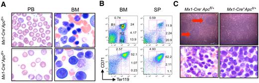 Figure 3. Apc-heterozygous mice developed ineffective erythropoiesis with erythroid dysplasia. (A) PB smears (left panels) and representative Giemsa-stained BM smears (right panels). (B) Flow cytometric analysis of BM and SP cells from representative Mx1-Cre+Apcfl/+ and Mx1-Cre−Apcfl/+ mice after pI-pC induction. The single-cell suspensions were simultaneously stained with anti-CD71 and anti-Ter119 antibodies. The numbers indicate the percentages of cells in each population. (C). Hematoxylin and eosin (H&E)–stained sections of adult SP (top panels) and Giemsa-stained spleen touch-preparations (bottom panels) from either control or anemic Apc heterozygous mice. The red arrows identify white pulp. Samples were obtained from both Mx1-Cre+Apcfl/+ and Mx1-Cre−Apcfl/+ mice 4 to 8 months after induction of the Apc deletion by pI-pC. Images were obtained using an Olympus microscope BX45 (Model U-DO3) equipped with an Olympus DP12 digital camera (A panels: 100× oil objective/1.25 NA, C top panels: 10× Plan air objective/0.3 NA, C bottom panels: 50× oil objective/0.9 NA), and processed using Microsoft PowerPoint.