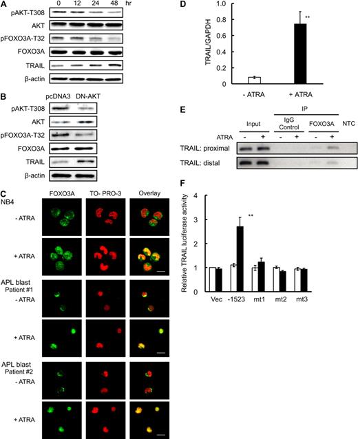 Figure 1. ATRA induces dephosphorylation of FOXO3A and translocation of FOXO3A into the nucleus. (A) NB4 cells were incubated with 1.0μM ATRA or a final volume of 0.1% ethanol for the indicated time periods. Total protein was extracted and analyzed by Western blotting using antibodies for the indicated antigens. β-actin was used as an internal control. (B) NB4 cells were transfected with empty vector (pcDNA3) or dominant negative form of AKT (DN-AKT) by electroporation. After incubation for 48 hours, the cells were harvested. Total protein was extracted and submitted to Western blotting with the indicated antibodies. (C) NB4 cells or APL blast cells from patients were incubated with 1.0μM ATRA or a final volume of 0.1% ethanol for 48 hours. After fixation and permeabilization, cells were incubated with anti-FOXO3A antibody and Alexa488-conjugated goat anti–rabbit IgG (green). The nuclei were stained with TO-PRO-3 (red). Confocal imaging analysis was performed using a Leica TCS-NT laser confocal microscope. Scale bar represents 10 μm. (D) TRAIL mRNA was detected by quantitative RT-PCR using TaqMan probes for TRAIL and GAPDH. Quantification was performed using the relative standard curve method. Results are presented as the mean ± SE of 3 independent experiments. **P < .01 compared with the ethanol control. (E) After cross-link reversal, the recovered DNA was subjected to ChIP analysis with FOXO3A antibody or normal serum IgG (as a control) using conventional PCR. The presence of promoter DNA before immunoprecipitation was confirmed by PCR (input). NTC refers to the no-template control, which lacked input DNA. (F) TRAIL promoter activity, as determined by measurement of luciferase activity, was assayed in NB4 cells transfected with the indicated constructs after a 48-hour incubation with 1.0μM ATRA (■) or a final volume of 0.1% ethanol (□). mt1, mt2, and mt3 represent the human TRAIL promoter gene that had a mutated proximal FOXO3A binding site, a mutated distal FOXO3A binding site, or both mutated sites. Results are presented as the mean ± SE of 3 independent experiments. **P < .01 compared with empty pGL2m vector-transfected control (Vec).
