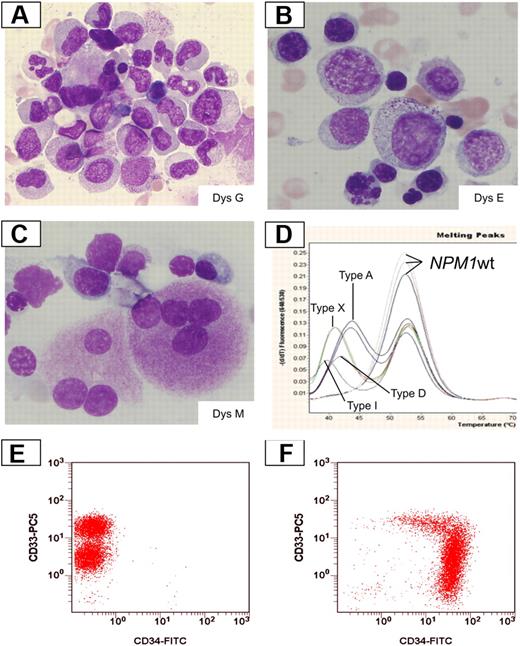 Figure 1. Dysplastic changes in smears from NPM1-mutated AML. (A) Dysgranulopoiesis (DysG) in a case of NPM1-mutated AML showing myeloid cells with hypogranulated cytoplasm and pseudo-Pelger cells. Bone marrow; Pappenheim staining. (B) Dyserythropoiesis (DysE) in a case of NPM1-mutated AML showing nuclear irregularity with fragmentation and multinucleation of red precursors. Bone marrow; Pappenheim staining. (C) Dysmegakaryopoiesis (DysM) in a case of NPM1-mutated AML showing 2 dysplastic megakaryocytes with multiple nuclei; Pappenheim staining. All images were collected using a Zeiss Axio Imager A1, 63×/1.4 oil objective Plan-Apochromat; 10×/23 eyepiece Sony camera 3CCD HD, and Model MC-HD 1/3 Horn imaging DHS solution. (D) LightCycler-based melting curve analyses showing different NPM1 mutation types in AML with MLD changes: type A (nt959insTCTG), type D (nt959insCCTG), type I (nt959insCTTG), type X (nt959insTTCC), and wild-type patients. (E-F) Expression of CD34 by multiparameter flow cytometry. A case with NPM1 mutation and MLD changes shows a lack of expression of CD34 (panel E, note the different levels of CD33 expression between myeloblasts and monoblasts). A different AML MLD+ case without NPM1 mutation shows a strong expression of CD34 with a part of the population lacking CD33 expression (F).