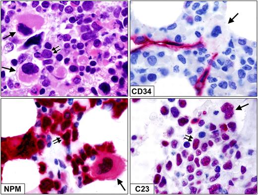 Figure 2. Dysplastic megakaryocytes in bone marrow biopsy from NPM1-mutated AML. (Top left) Infiltration by myeloid blasts (double arrows) admixed with dysplastic, monolobated megakaryocytes (single arrows; paraffin sections; hematoxylin-eosin. (Top right) Myeloid blasts as well as a monolobated megakaryocyte (single arrow) are CD34−. CD34+ small vessels serve as positive control. (Bottom left) Myeloid blasts (double arrows) and a dysplastic monolobated megakaryocyte (single arrow) show aberrant cytoplasmic expression of NPM. (Bottom right) Myeloid blasts (double arrows) and a dysplastic monolobated megakaryocyte (single arrow) show nucleus-restricted expression of nucleolin/C23. Immunostainings for CD34, NPM, and C23 were shown with the APAAP technique (hematoxylin counterstaining). All images were collected using an Olympus B61 microscope and a Plan Fl 100×/1.3 NA oil objective; Camedia 4040, Dp_soft Version 3.2; and Adobe Photoshop 7.0.