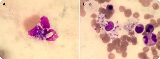 A 16-year-old female with AIDS presented with 3 months' history of fever, loose stools, and significant weight loss. She had marked pallor, erythematous plaques on the face and neck, enlarged liver and spleen 2.0 cm, below the respective costal margins, and bilateral cervical lymphadenopathy. Both her parents had been suffering from AIDS and subsequently died of disseminated tuberculosis. / Her chest x-ray was normal and ultrasonography affirmed hepatosplenomegaly. HIV serology was positive and CD4 count was 0.012 × 109/L. Complete blood counts showed pancytopenia with hemoglobin of 57 g/L, total leukocyte count of 1.1 × 109/L, and platelet count of 18 × 109/L. The peripheral blood film (panel A) revealed monocytes and neutrophils with the presence of yeast-like intracellular organisms, 2 to 4 μm in diameter. These organisms had an eccentric chromatin and pseudocapsule, confirming to the morphology of Histoplasma capsulatum. There was evidence of histoplasmosis in 5% of the leukocytes. Bone marrow aspirate smear (panel B) and biopsy showed numerous histiocytes containing abundant intracellular organisms. These organisms stained bright pink on periodic acid-Schiff stain. / Treatment with amphotericin B was started immediately; however, the patient succumbed to the infection. / A high index of suspicion and a careful examination of the peripheral blood smear may disclose histoplasmosis.