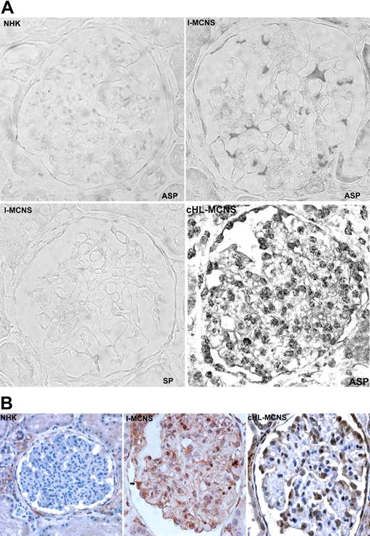 Figure 1. c-mip is up-regulated in the glomeruli of 8 patients with cHL-MCNS. (A) The top panel is representative ISH of c-mip transcript in serial sections from normal human kidney (NHK) and kidney biopsy specimens of patients with I-MCNS and cHL-MCNS. ASP indicates antisense probe; and SP, sense probe. (B) Representative immunohistochemistry on serial sections of normal human kidney and kidney biopsy samples from patients with I-MCNS and cHL-MCNS at an original magnification of ×40. c-mip up-regulation was detected in the podocytes of all patients with cHL-MCNS.