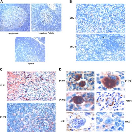 Figure 2. Up-regulation of c-mip in lymph nodes of 8 patients with cHL-MCNS is restricted to HRS cells. (A) Immunohistochemistry analysis of c-mip in normal lymphoid tissues (thymus, lymphoid follicle of the spleen and lymph nodes). Note that c-mip is not seen in normal tissues, except in the transitional zone of node tissue and in the lymphoid follicle (indicated by arrows) at an original magnification of ×20. (B) Representative image showing c-mip in lymphomatous tissues from 2 patients with isolated cHL at an original magnification of ×20. HRS cells are indicated by arrows. Note that c-mip is undetectable in lymphomatous tissues from isolated cHL. (C) Representative expression of c-mip in lymphomatous tissues from 2 patients with cHL-MCNS at an original magnification of ×20. c-mip shows intense staining in cHL-MCNS, restricted to HRS cells. (D) Localization of c-mip in HRS cells from 4 patients with cHL-MCNS. No staining was detected in the HRS cells of 2 patients with isolated cHL at an original magnification of ×100. c-mip up-regulation in HRS cells was found in all patients with cHL-MCNS, whereas no immunostaining was observed for c-mip in 9 control cases with isolated cHL