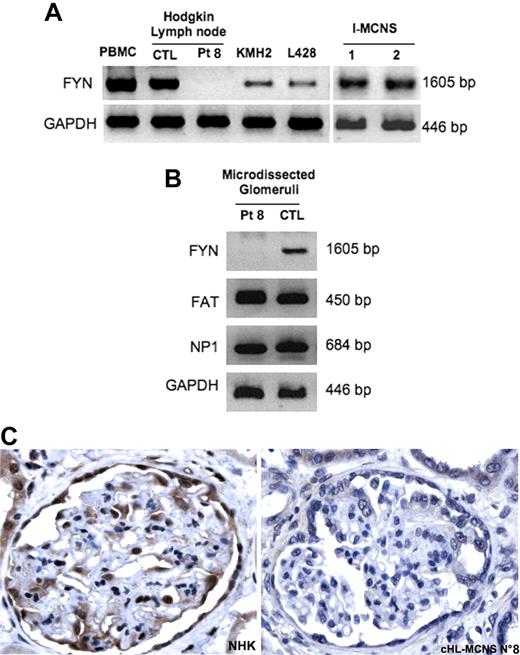 Figure 5. Absence of Fyn detection in lymphomatous tissue and in microdissected glomeruli from one patient with cHL-MCNS. (A) Analysis of Fyn expression by RT-PCR in normal PBMC, in lymphomatous tissue from patient no. 8 and a control patient with isolated cHL, in the PBMC of 2 patients with an I-MCNS relapse and in HRS cell lines. (B) Analysis of Fyn expression in microdissected glomeruli from patient no. 8 and a control patient without glomerular disease. Notably, transcripts for FAT and NP1 were easily detected in the microdissected glomeruli. (C) Immunohistochemistry analysis of Fyn protein in normal human kidney (left panel) and in a kidney biopsy specimen from patient no. 8 (right panel). Note the absence of Fyn protein from podocytes of patient no. 8.