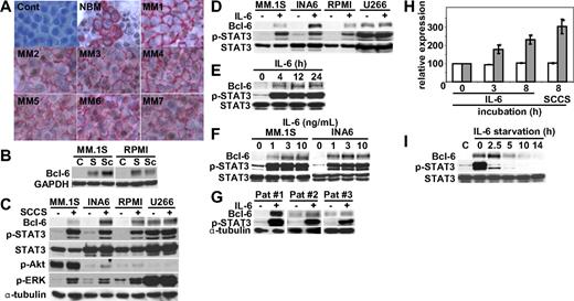 Figure 1. IL-6 in SCCSs induces Bcl-6. (A) Immunohistochemical analysis for Bcl-6 expression was performed on bone marrow (BM) tissue microarrays from healthy donors (NBM) and multiple myeloma (MM) patients. Representative results are shown. CD138 is stained in red; Bcl-6 is stained in brown. Control sample was stained without anti–Bcl-6 antibodies or anti-CD138. See supplemental Methods for image-acquisition information. (B) MM.1S and RPMI8226 cells were cultured with stromal cell–culture supernatants (SCCSs; S) or bone marrow stromal cells (BMSCs; Sc) for 12 hours. (C) MM.1S, interleukin-6 (IL-6)–starved INA6, RPMI8226, and U266 cells were cultured with SCCSs for 12 hours. (D) MM.1S, IL-6–starved INA6, RPMI8226, and U266 cells were cultured with IL-6 (5 ng/mL) for 12 hours. (E) MM.1S cells were cultured with IL-6 (5 ng/mL) for the indicated time periods. (F) MM.1S and IL-6–starved INA6 cells were cultured with IL-6 (1, 3, or 10 ng/mL) for 12 hours. (G) Patient MM cells were cultured with IL-6 (5 ng/mL) for 12 hours. (H) INA6 cells were cultured with IL-6 (5 ng/mL for 3 hours and 8 hours) or SCCSs for 8 hours. Total RNA was extracted, and Bcl-6 gene expression was examined by real-time RT-PCR () and normalized to expression of glyceraldehyde-3-phosphate dehydrogenase (□), which served as an internal control. *P < .01. (I) INA6 cells were cultured with or without IL-6 (5 ng/mL) for 12 hours. Cells were then washed and cultured for the indicated time periods. Whole-cell lysates were subjected to immunoblotting with indicated antibodies. Phospho-STAT3 served as positive control for IL-6–induced signal transduction.