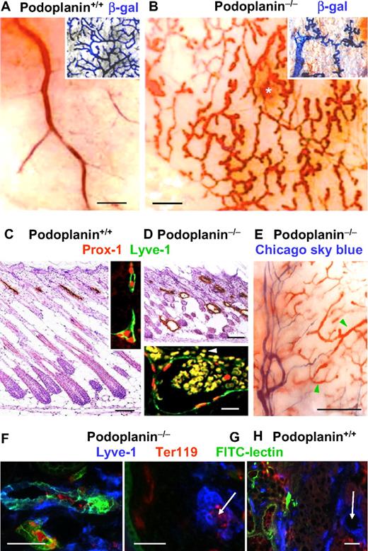 Figure 2. Malformations and blood perfusion (the “nonseparation” phenotype) of cutaneous lymphatic vessels in podoplanin−/− mice. (A) In a wild-type P3, mouse the en face view of the dermal side of the skin of the flanks and abdomen shows blood-filled veins of different calibers. The lymphatic system is visualized by VEGFR-3–driven, lymphatic endothelium–specific expression of β-galactosidase (inset). (B) By contrast, in P3 podoplanin−/− mice, a fractal pattern of blood-filled, tortuous, blind-ending vessels are found, besides occasional areas of bleeding (white asterisk). These vessels are of lymphatic origin because they express VEGFR-3–driven β-galatosidase (inset); Olympus SZ zoom stereo microscope, Sony DSC W200 camera with adapter VAE-WD. (C) Sections through the flank skin of P3 podoplanin+/+ mice show Lyve-1–expressing lymphatics (brown) in the upper dermis. These vessels also express Prox-1 (red) on top of Lyve-1 (green) by double immunofluorescence (inset). (D) Skin of age-matched podoplanin−/− mice contains extended, randomly distributed lymphatic vessels. Their endothelial cells express Prox-1 (red) and Lyve-1 (green), and their dilated lumen contains erythrocytes (yellow) that also have leaked into the perivascular space (white arrowhead; inset). (E) In a P3 podoplanin−/− mouse, intravenously injected Chicago sky blue fills dermal veins and arteries (“purple vessel” on the left side of the image; Olympus SZ40); however, the blood-filled lymphatics (green arrowheads) are not entered by the tracer, indicating that this compartment is already sequestered from the circulation in this P3 mouse. Identification of perfused lymphatic vessels (F) by intravenous injection of FITC-lectin (green). Lyve-1 is blue and Ter119 is red. FITC-lectin is not detectable in the small erythrocyte-filled lymphatic capillaries (arrow in panel G). (H) Control injection of FITC-lectin into wild-type mice. FITC-lectin is confined to blood vessels and not detectable in large (arrow) or small lymphatic vessels (the latter are not shown in this picture). Scale bars in panels A, B, and E equal 300 μm; in panels C and D, 100 μm; in panel D inset, 15 μm; and in panels F through H, 50 μm.